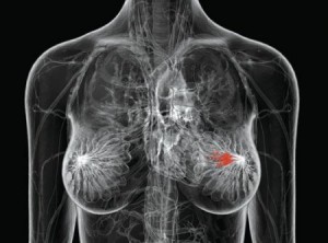 Immagine digitale di busto di donna con tumore alla mammella. 